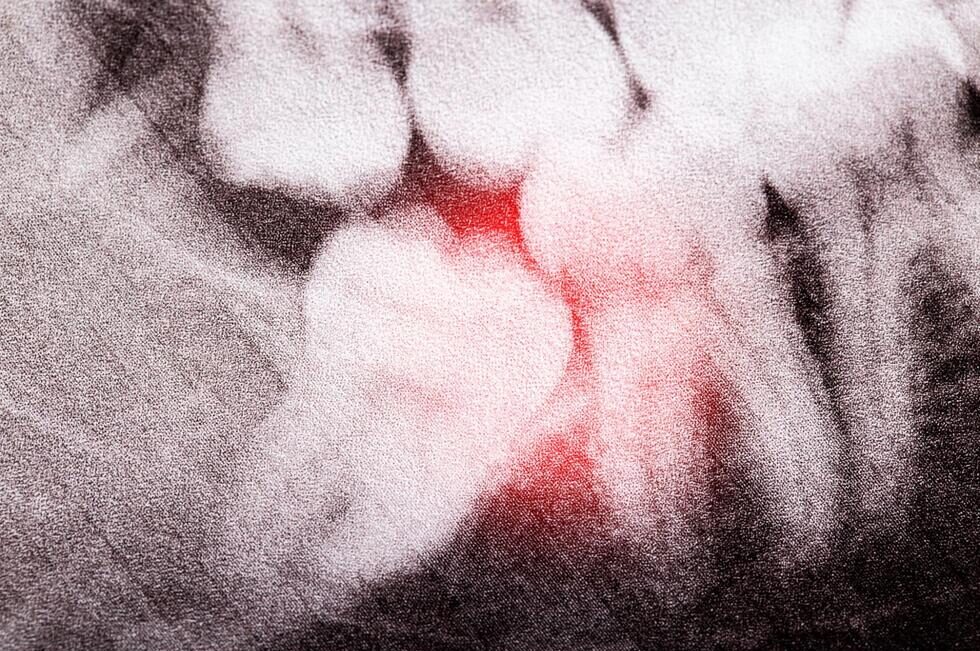炎症を起こしている親知らずのレントゲン写真。埋伏した奥歯の周囲に赤色の病変がハイライトされている。
