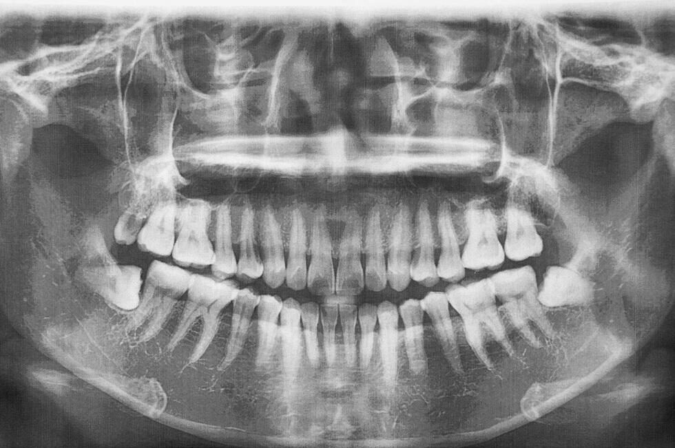 歯のレントゲン画像
