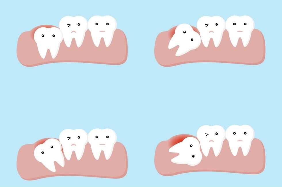 親知らずの様々な生え方が描かれたイラスト