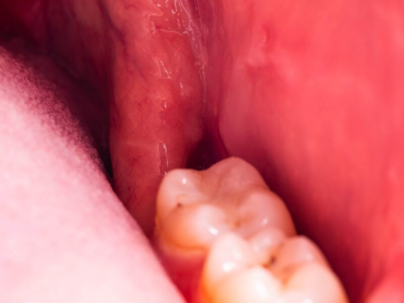 ドライソケットってなに？痛み＝全部ドライソケットではありません