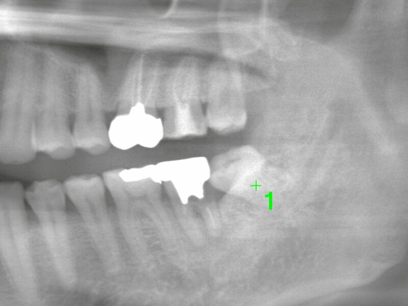 トライアスリートと親知らず抜歯 — 長距離レースを戦う身体を守るために —