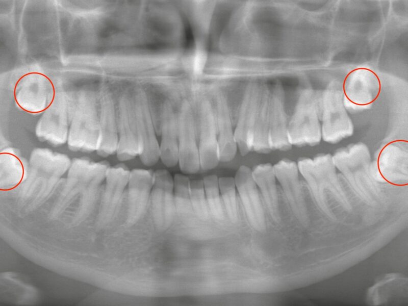 4本抜歯したい時、どうスケジュールを組む？<br>—矯正治療と親知らず抜歯の最適な進め方—