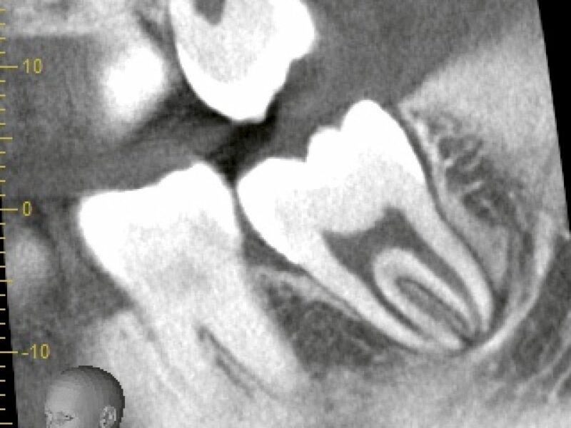【親知らずと神経】パノラマでは「重なって見える」のに、CTでは「離れている」ことがあります