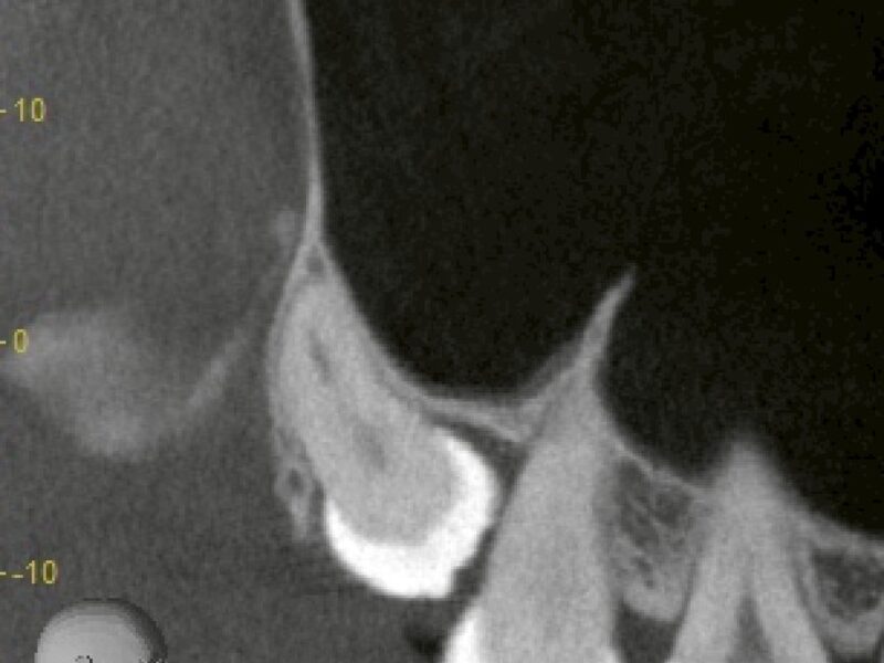 他院からの抜歯依頼｜上顎洞に近接した親知らずの抜歯は摘出に近い治療です