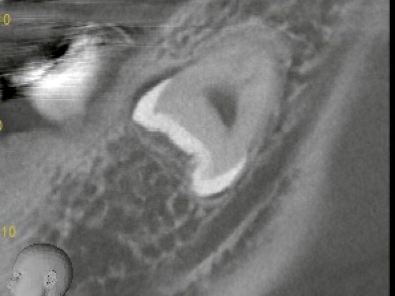 親知らずの抜歯は本当に必要？抜歯のベネフィットから考える正しい判断