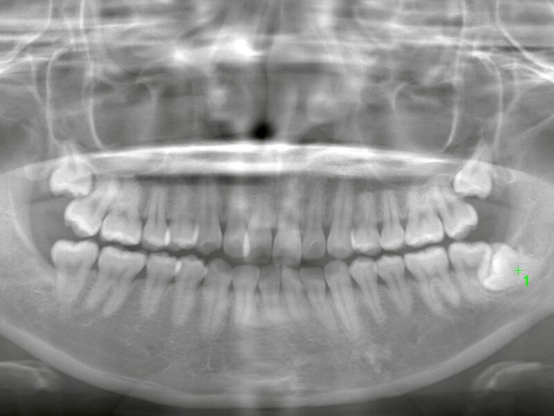 親知らずは何本まで同時に抜ける？複数本抜歯のリスクと安全な判断基準