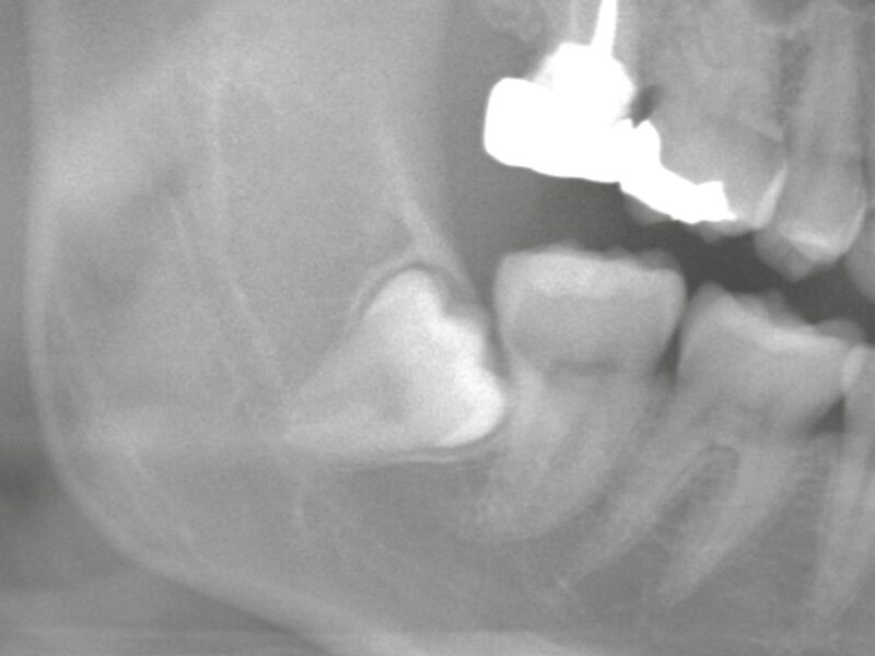 親知らずの抜歯後、腫れはどのくらい出るのか ― 難抜歯専門クリニックだからこそ、正直にお伝えします ―