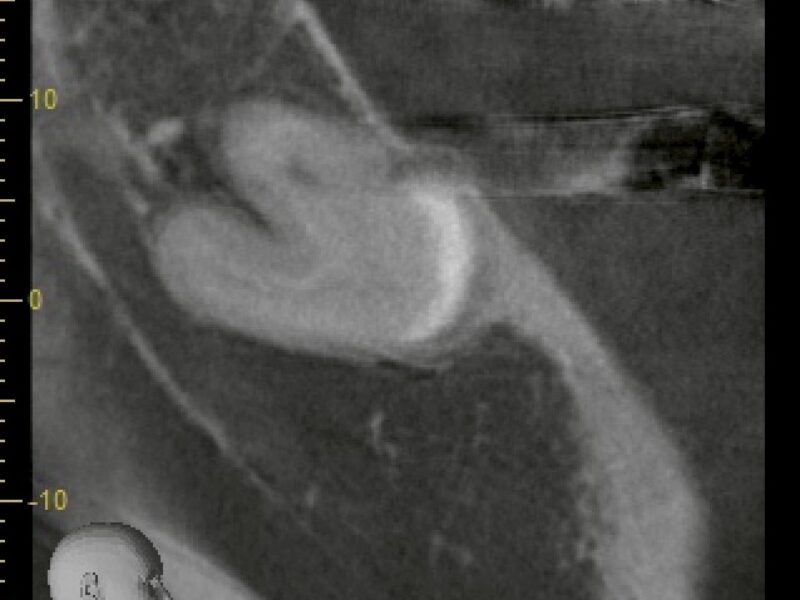 埋伏した親知らずの抜歯｜「難しい」と言われたケースでも、安全に行うために