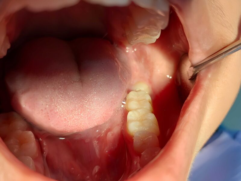 親知らずの移植という選択肢