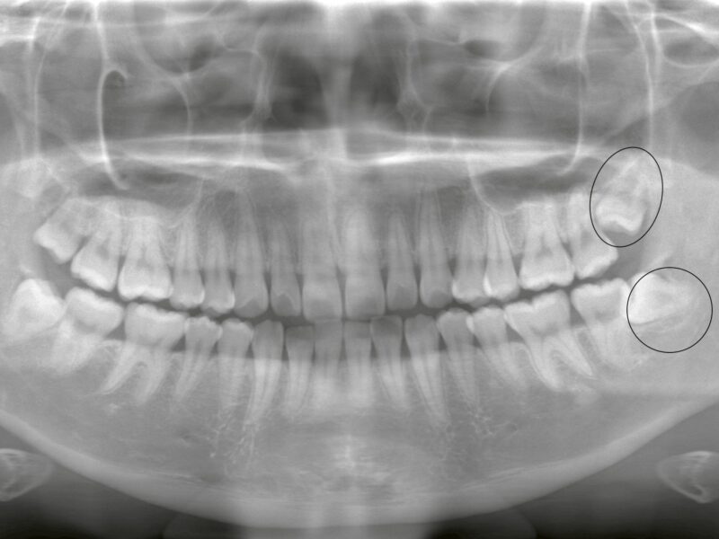 親知らずの抜歯は本当に難しい？<br>「難しいから抜けない」と言われたケースの見極めポイント