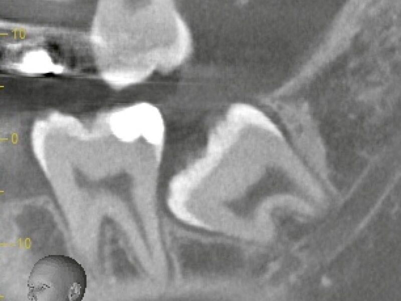 16歳で親知らずは抜くべき？歯根未完成で抜歯するメリット・デメリットを解説