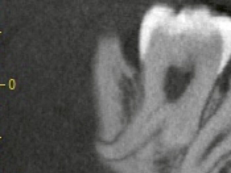 親知らずはなぜ難抜歯になりやすい？実は形がかなり特殊です