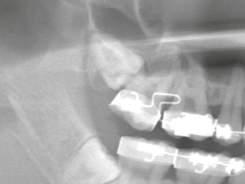 上顎洞に近い上の親知らず抜歯｜「穴が空く？」口腔上顎洞交通のリスクと術後注意