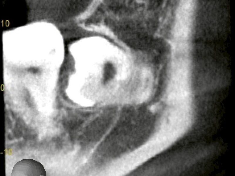 【完全埋伏×湾曲歯根】下歯槽神経・上顎洞に近接した親知らずを上下同時抜歯した症例