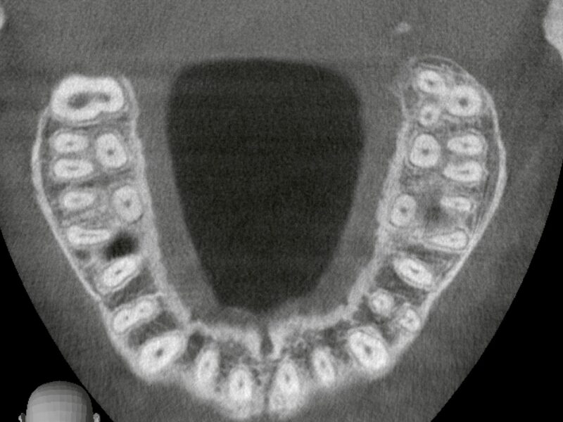 矯正治療に伴う第一小臼歯抜歯｜CTで左右差を見極めた症例