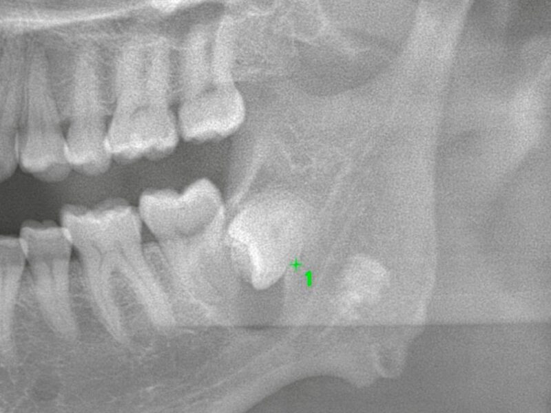 【親知らず抜歯後の痛み】ドライソケットとの違いとは？エビデンスに基づいて解説