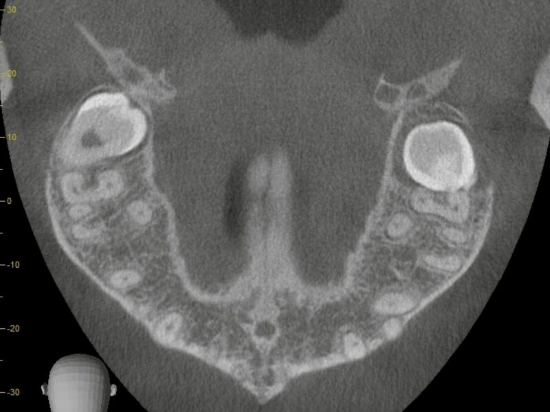 上顎洞に近接した深い埋伏上顎親知らず｜CTで判明した「逆向き」の歯も同日抜歯した症例